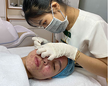 SẠCH MỤN BIO ACNE